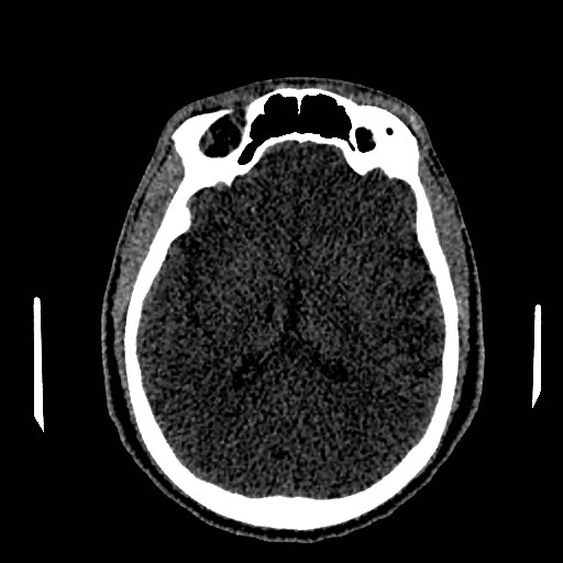Acute basilar artery occlusion (Radiopaedia 43582-46985 Axial non-contrast 99).jpg