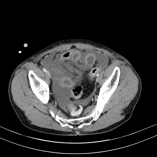 Acute bowel ischemia (Radiopaedia 87695-104114 Axial C+ portal venous phase 73).jpg