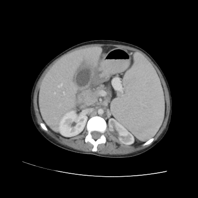 Acute calculous cholecystitis in patient with osteopetrosis (Radiopaedia 77871-90159 Axial C+ portal venous phase 37).jpg