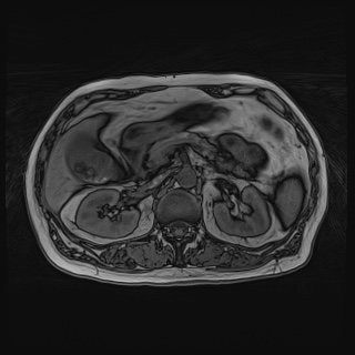 File:Acute cholecystitis (Radiopaedia 72392-82923 Axial T1 out-of-phase 56).jpg