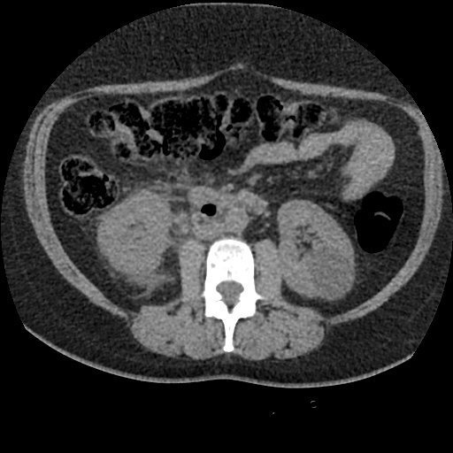 Acute cholecystitis and ureteric colic (Radiopaedia 42330-45444 Axial prone 48).jpg