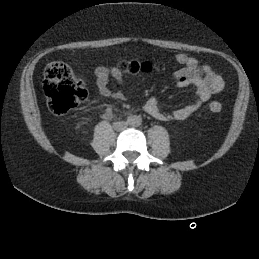 Acute cholecystitis and ureteric colic (Radiopaedia 42330-45444 Axial prone 59).jpg