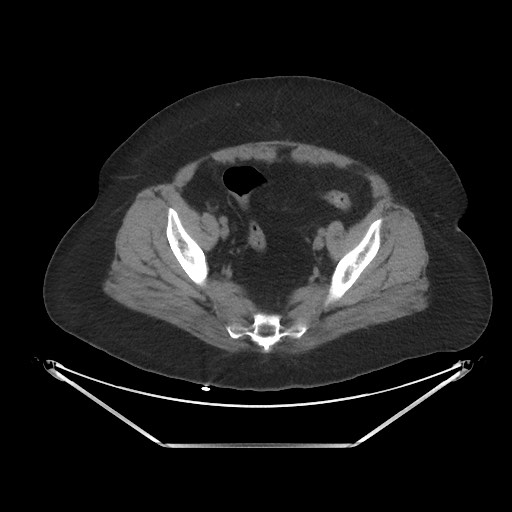 File:Acute cholecystitis with tensile fundus sign (Radiopaedia 71394-81723 Axial non-contrast 97).jpg