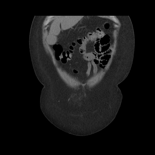 Acute cholecystitis with tensile fundus sign (Radiopaedia 71394-81723 Coronal non-contrast 29).jpg