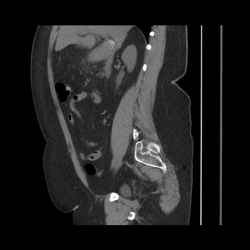 Acute cholecystitis with tensile fundus sign (Radiopaedia 71394-81723 Sagittal non-contrast 73).jpg