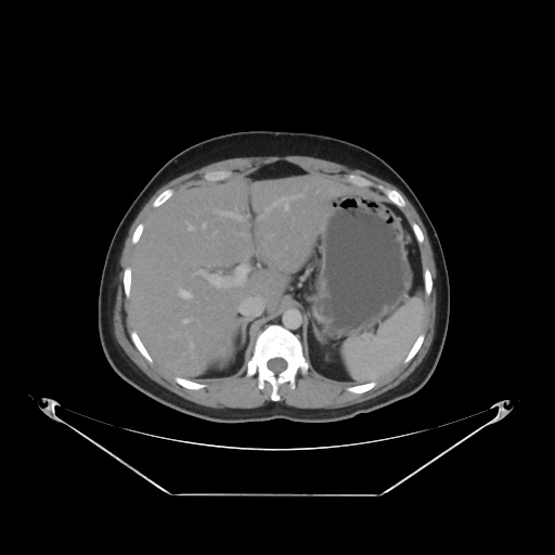 File:Acute complicated calculous cholecystitis (Radiopaedia 55202-61587 Axial C+ delayed 29).jpg