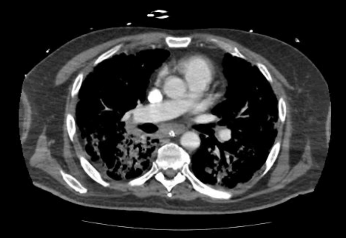 File:Acute cor pulmonale (ultrasound) (Radiopaedia 83508-98818 Axial C+ CTPA 37).jpg