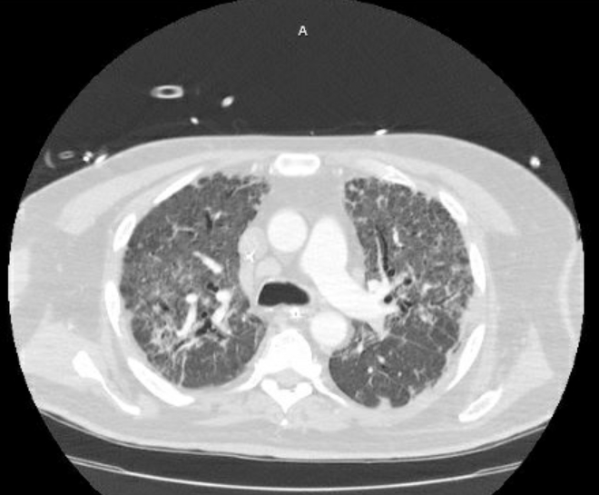 Acute cor pulmonale (ultrasound) (Radiopaedia 83508-98818 Axial lung window 34).jpg