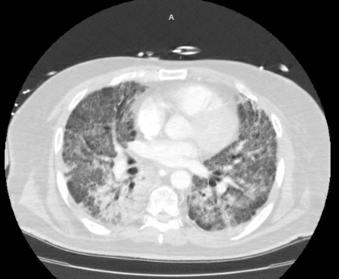 Acute cor pulmonale (ultrasound) (Radiopaedia 83508-98818 Axial lung window 52).jpg