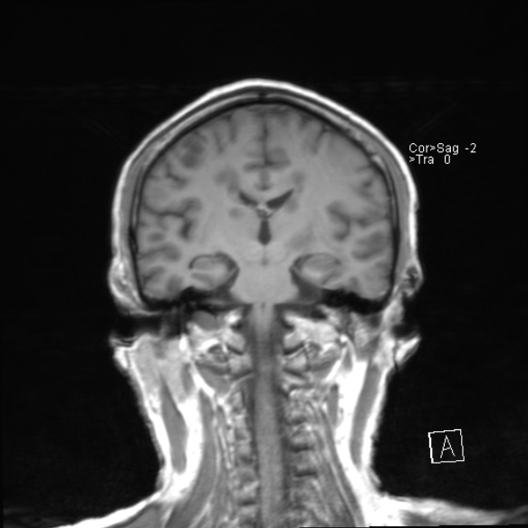File:Acute disseminated encephalomyelitis (Radiopaedia 37253-39033 Coronal T1 15).jpg