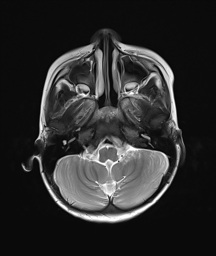 File:Acute disseminating encephalomyelitis with bilateral optic neuritis (Radiopaedia 79676-92886 Axial T2 5).jpg