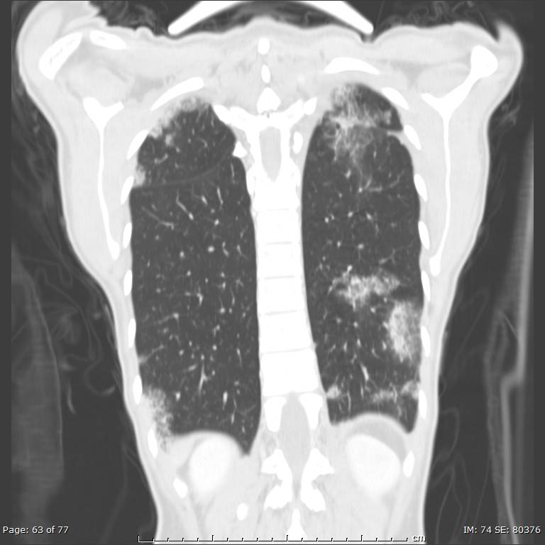 Acute eosinophilic pneumonia (Radiopaedia 48211-53073 Coronal lung window 43).jpg