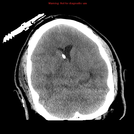 File:Acute hemorrhagic leukoencephalitis (Radiopaedia 14076-72275 Axial non-contrast 17).jpg