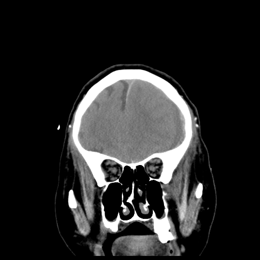 Acute hemorrhagic stroke (Radiopaedia 17507-17223 Coronal non-contrast 12).jpg