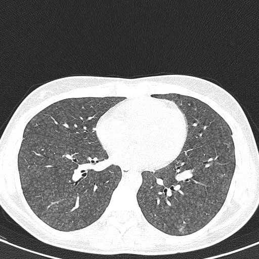 File:Acute hypersensitivity pneumonitis (Radiopaedia 85293-100870 Axial lung window 73).jpg