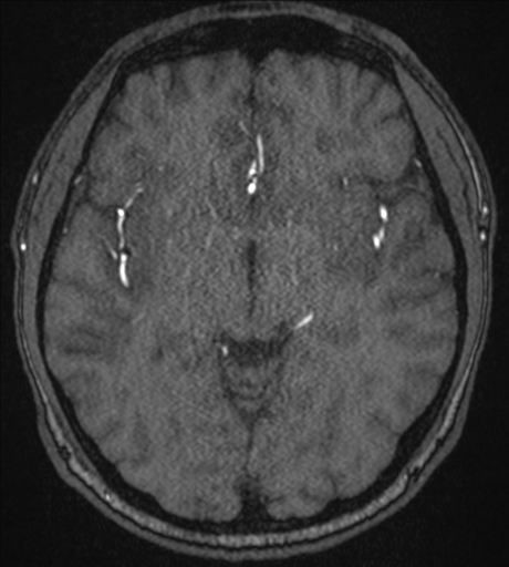 Acute left middle cerebral artery territory infarct with clot retrieval (Radiopaedia 47732-52433 Axial MRA 30).png