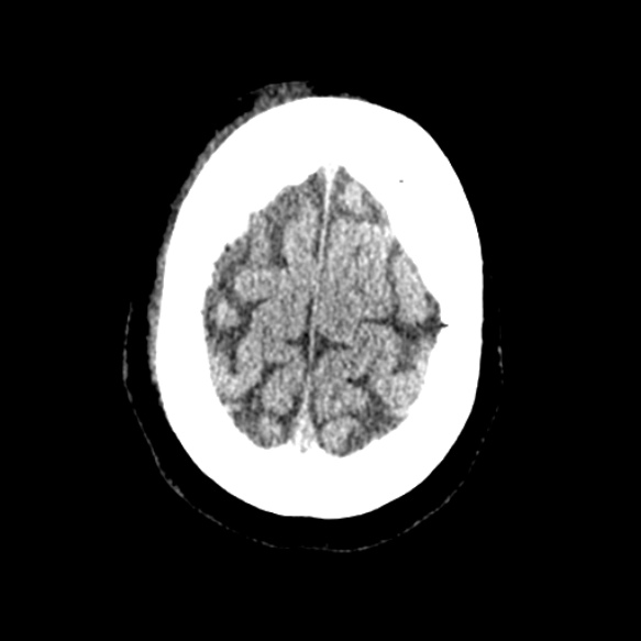 Acute middle cerebral artery territory infarct (Radiopaedia 52380-58283 Axial non-contrast 94).jpg