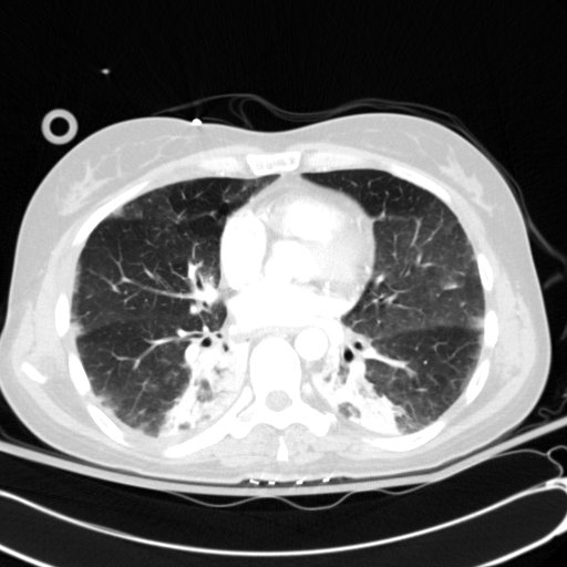 Acute myocardial infarction in CT (Radiopaedia 39947-42415 Axial lung window 74).jpg