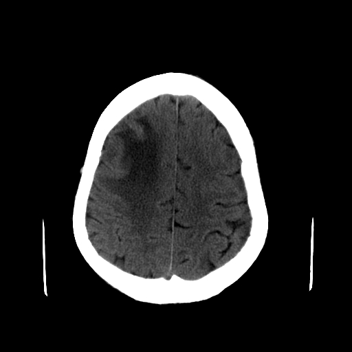 File:Acute necrotizing toxoplasma encephalitis (Radiopaedia 10683-11150 B 9).jpg
