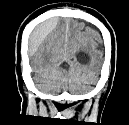 Acute on chronic subdural hematoma (Radiopaedia 78346-90966 Coronal non-contrast 53).jpg