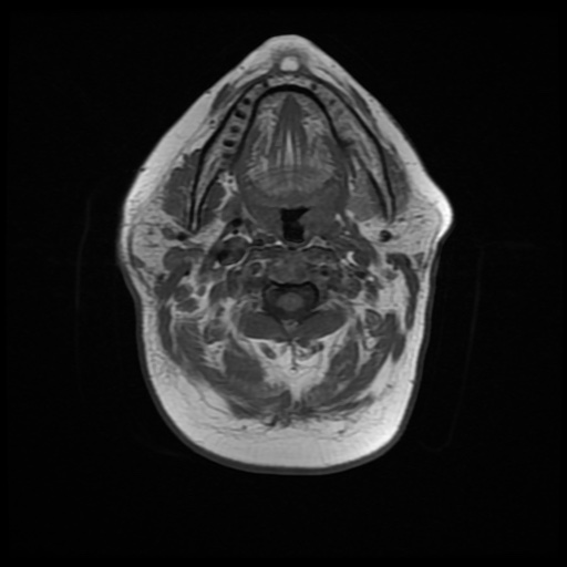 File:Acute otitis externa (Radiopaedia 57296-64236 Axial T1 16).jpg