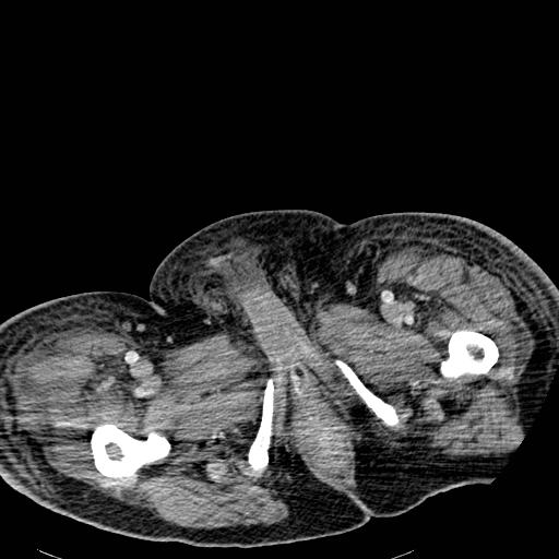 Acute pancreatic necrosis (Radiopaedia 13560-18501 Axial C+ portal venous phase 162).jpg