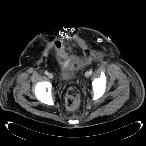 Acute pancreatic necrosis (Radiopaedia 13560-18503 Axial C+ portal venous phase 74).jpg