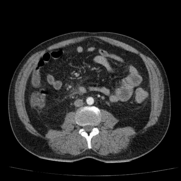 Acute pancreatitis (Radiopaedia 26663-26813 Axial C+ arterial phase 58).jpg