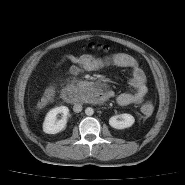 Acute pancreatitis (Radiopaedia 26663-26813 Axial C+ portal venous phase 40).jpg