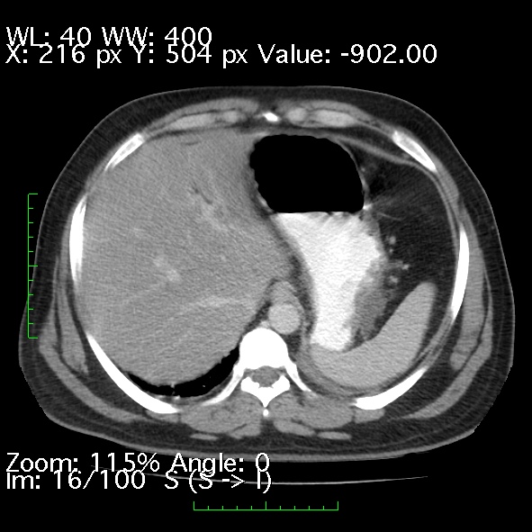 Acute pancreatitis (Radiopaedia 34043-35276 Axial C+ portal venous phase 16).jpg