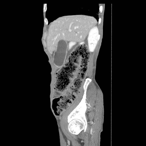 File:Acute pancreatitis (Radiopaedia 50213-55558 Sagittal C+ portal venous phase 7).jpg