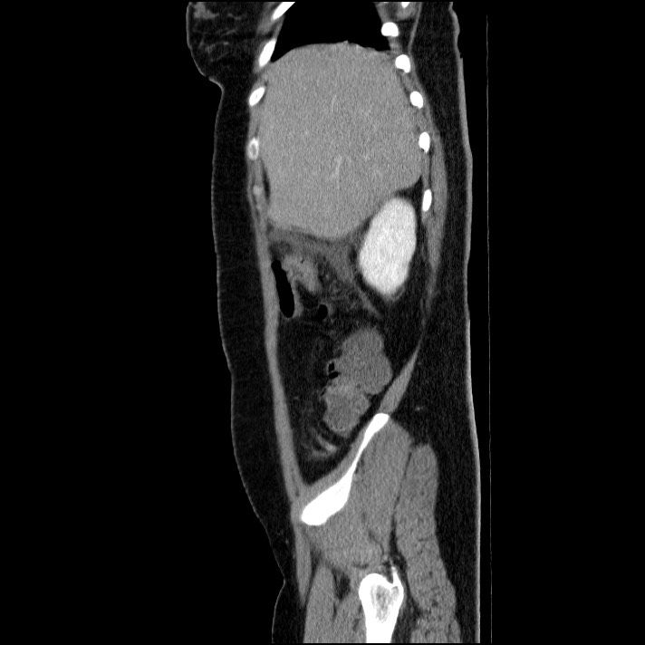 Acute pancreatitis (Radiopaedia 69236-79012 Sagittal C+ portal venous phase 78).jpg