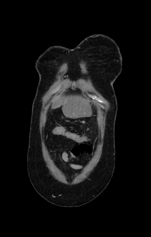 Acute pancreatitis (Radiopaedia 80007-93285 Coronal C+ portal venous phase 1).jpg