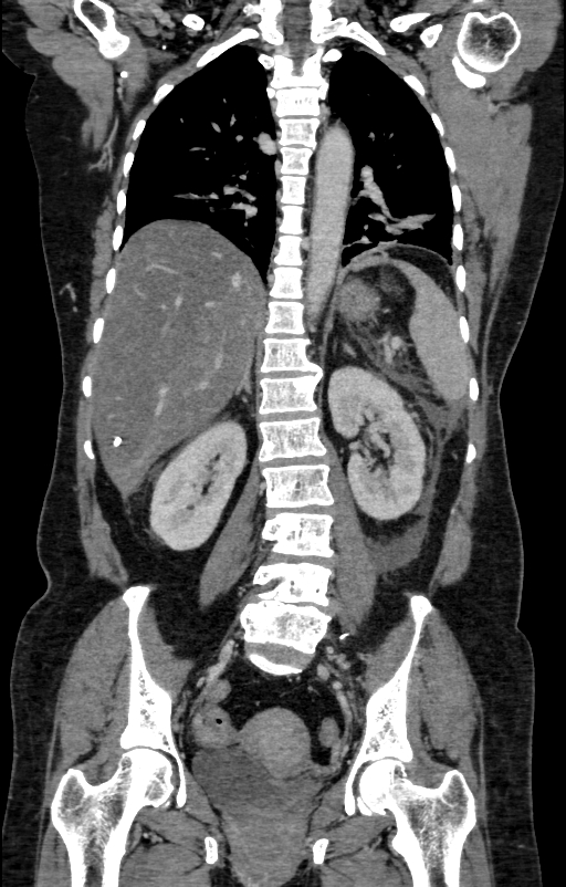 Acute pancreatitis (Radiopaedia 80007-93285 Coronal C+ portal venous phase 98).jpg