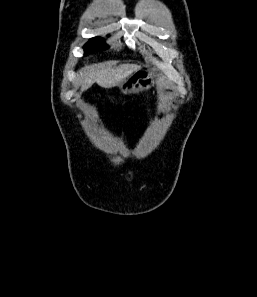 Acute pancreatitis (Radiopaedia 87428-103757 Coronal C+ portal venous phase 7).jpg