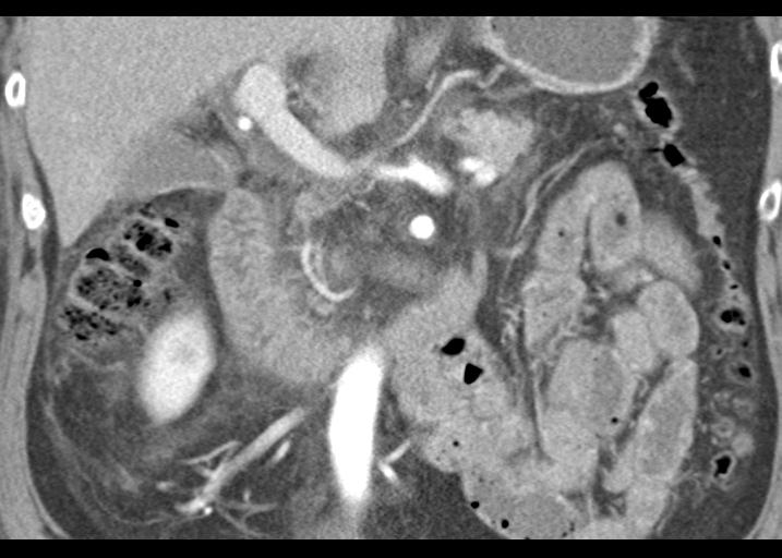 Acute pancreatitis and walled-off necrosis (Radiopaedia 29888-30403 Coronal C+ portal venous phase 29).jpg