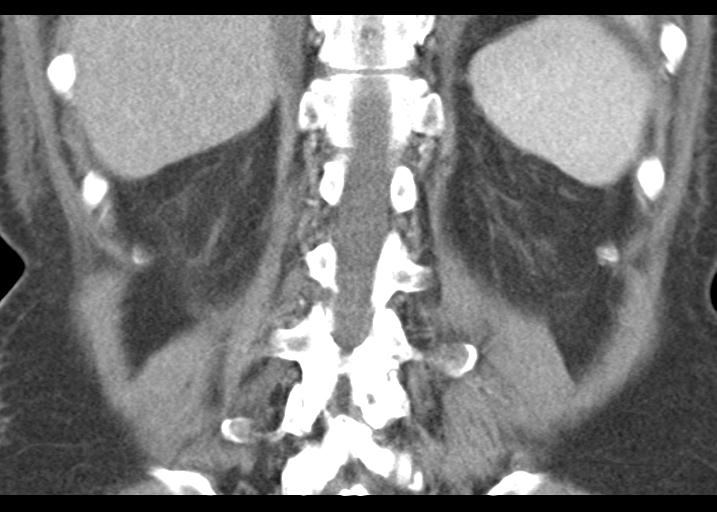 Acute pancreatitis and walled-off necrosis (Radiopaedia 29888-30403 Coronal C+ portal venous phase 45).jpg