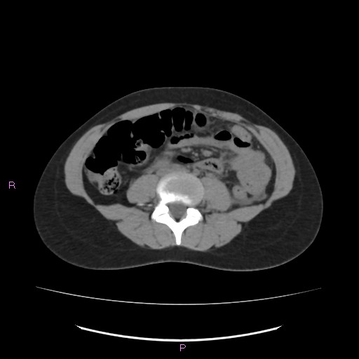 Acute pancreatitis secondary to stone at minor papilla and pancreatic divisum (Radiopaedia 76570-88333 Axial non-contrast 42).jpg