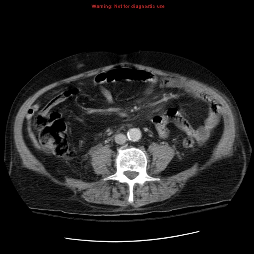 File:Acute pancreatitis with incidental pancreatic lipoma (Radiopaedia 10190-10730 Axial C+ portal venous phase 46).jpg