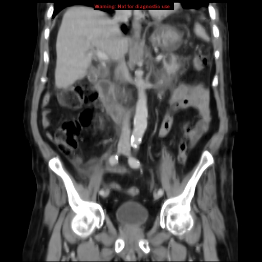 Acute pancreatitis with incidental pancreatic lipoma (Radiopaedia 10190-10730 Coronal C+ portal venous phase 36).jpg