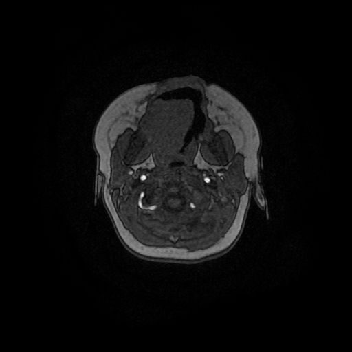 Acute phase of hemiconvulsion-hemiplegia epilepsy syndrome (Radiopaedia 29309-29745 Axial TOF angiography 162).jpg