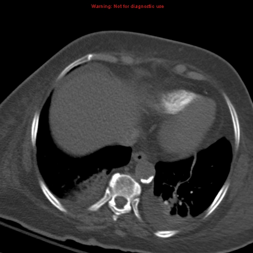 Acute pulmonary embolism (Radiopaedia 13286-13289 Axial C+ CTPA 52).jpg