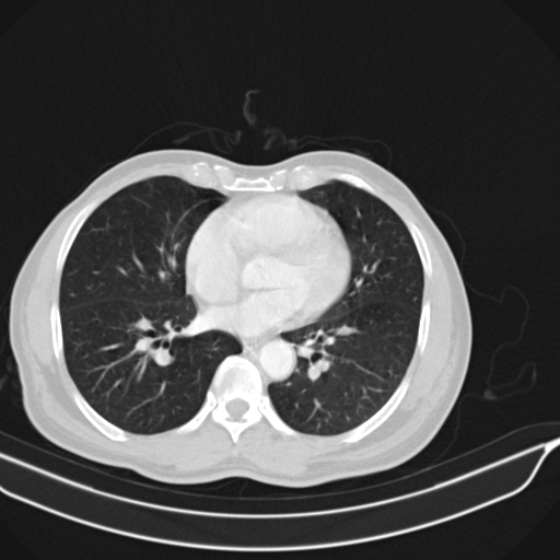 Acute pulmonary embolism (Radiopaedia 69510-79390 Axial lung window 46).jpg