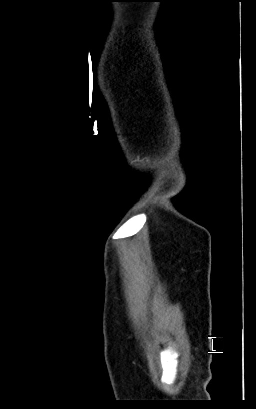 Acute renal infarction (Radiopaedia 59375-66736 Sagittal C+ portal venous phase 3).jpg