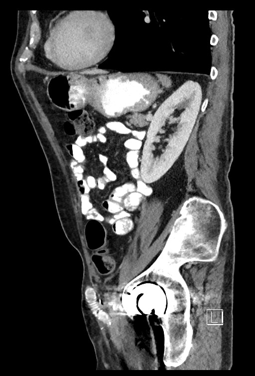 Acute renal infarction - rim capsular enhancement (Radiopaedia 59833-67270 Sagittal C+ portal venous phase 31).jpg