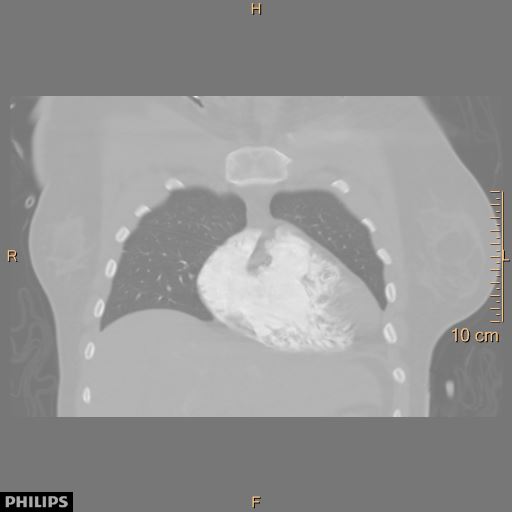 File:Acute reversible pulmonary hypertension and right heart failure from cocaine toxicity (Radiopaedia 49394-54517 Coronal 13).jpg