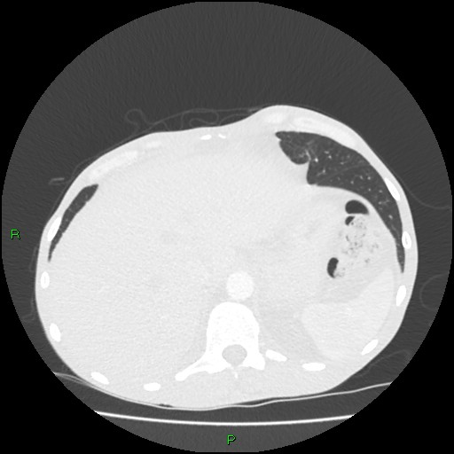 File:Acute right lung abscess (Radiopaedia 34806-36258 Axial lung window 170).jpg