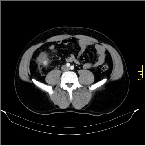 Acute right sided diverticulitis (Radiopaedia 65249-74268 Axial C+ portal venous phase 48).JPG