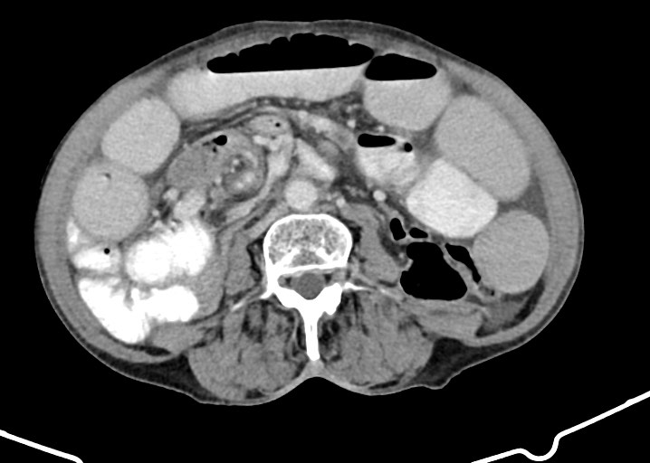 Acute small bowel (ileal) volvulus (Radiopaedia 71740-82139 Axial C+ portal venous phase 114).jpg