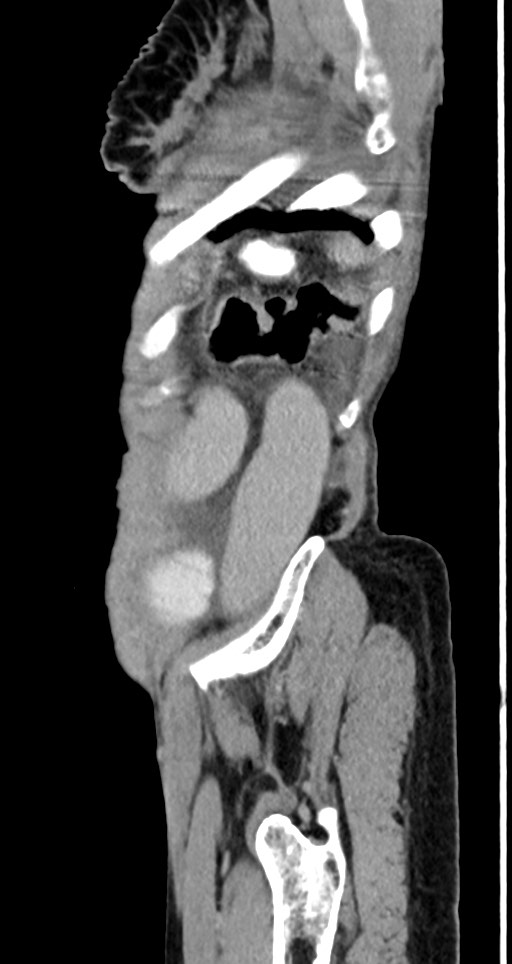 Acute small bowel (ileal) volvulus (Radiopaedia 71740-82139 Sagittal C+ portal venous phase 31).jpg